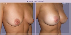 Before and after image of a breast augmentation procedure.